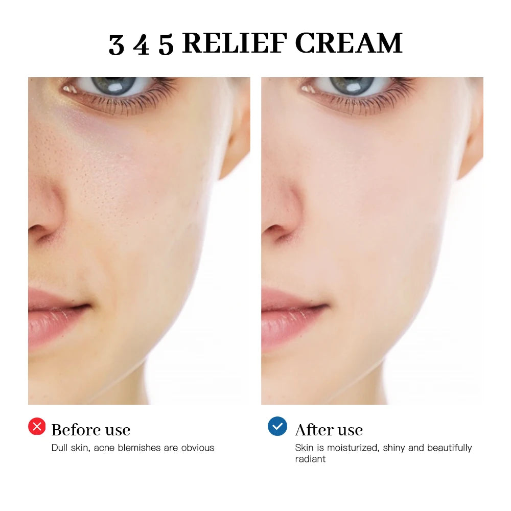 Before and after comparison of skin with '3 4 5 Relief Cream' showing improved skin texture.